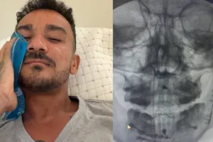Danilo, do Flamengo, publica exame com placas e parafusos após cirurgia na mandíbula