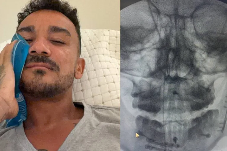 Danilo, do Flamengo, publica exame com placas e parafusos após cirurgia na mandíbula